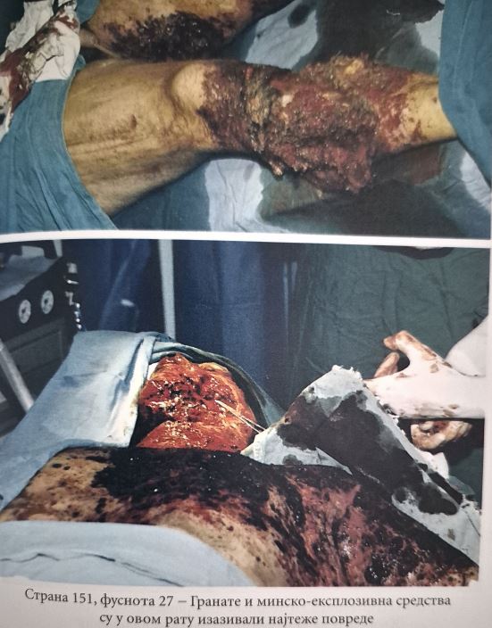 Гранате и минско експлозивна средства су у овом рату изазивали најтеже повреде